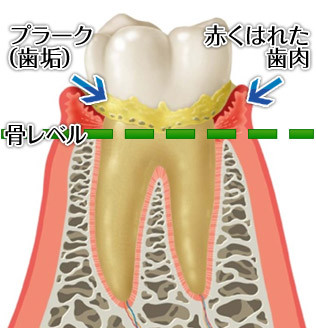 歯肉炎の歯茎
