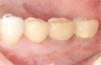 歯周外科処置歯肉が薄い改善