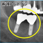 奥歯のインプラントレントゲン写真